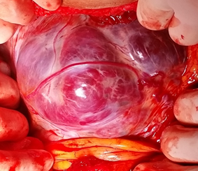 前置胎盘合并胎盘植入保留子宫的治疗措施-中国妇产科