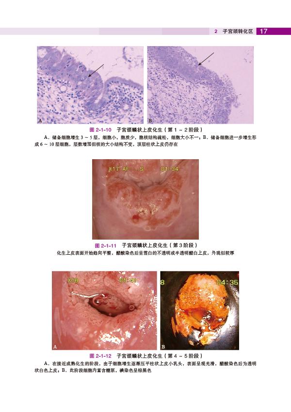 子宫颈转化区特征(2《子宫颈疾病—阴道镜图释》