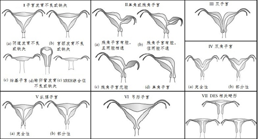 图1  美国生育协会提出的子宫畸形分型图(1988年)