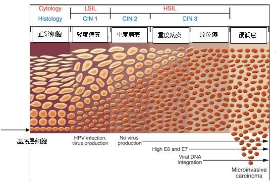 0期:原位癌,癌只限于宫颈上皮并没有局部侵润.